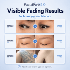 Profesjonalny Laser Pikosekundowy LASER FacialPure 5.0 w Walizce – Bezinwazyjne i Bezbolesne Usuwanie Tatuażu oraz Brwi, Technologia Brilliant Black