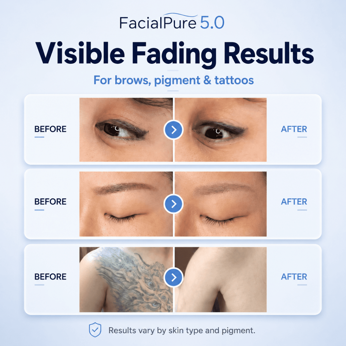 Profesjonalny Laser Pikosekundowy LASER FacialPure 5.0 w Walizce – Bezinwazyjne i Bezbolesne Usuwanie Tatuażu oraz Brwi, Technologia Brilliant Black