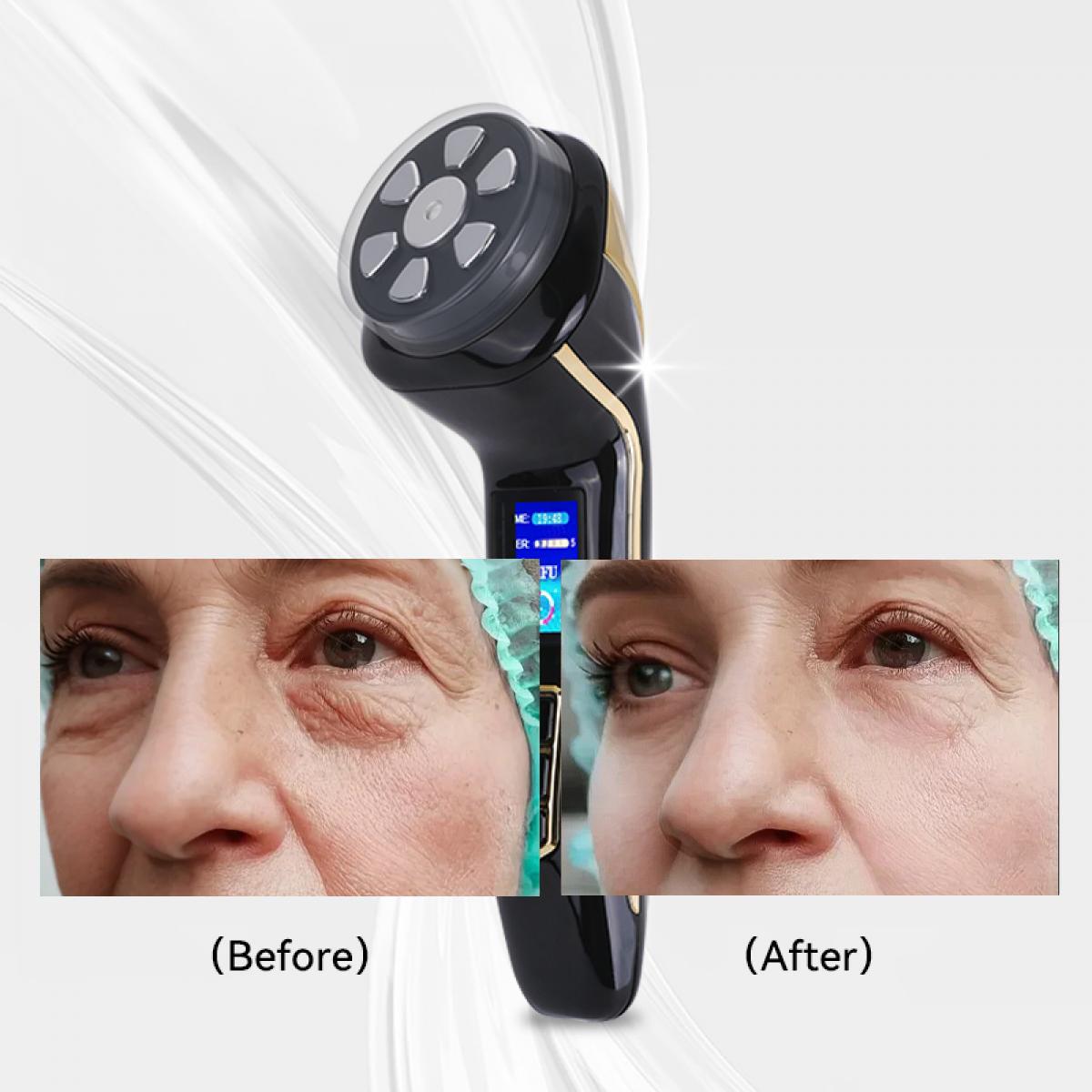 FREYARA HIFU - FacialDefy 2.0, przenośne i podręczne urządzenie HIFU 4w1 z mikroogniskowanymi ultradźwiękami, ulepszona moc, szybszy lifting, widoczne rezultaty