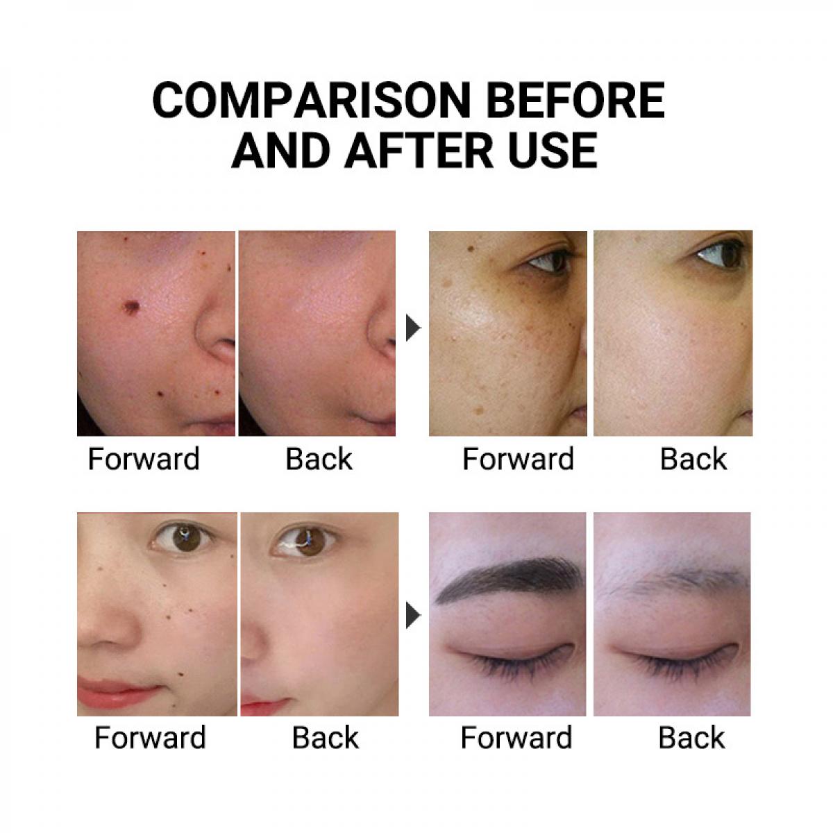 LASER FacialPure LS006, bezprzewodowe pióro laserowe pikosekundowe do użytku domowego, odpowiednie do usuwania piegów, tatuaży, przebarwień i zmian pigmentacyjnych skóry, bezprzewodowe i trwałe